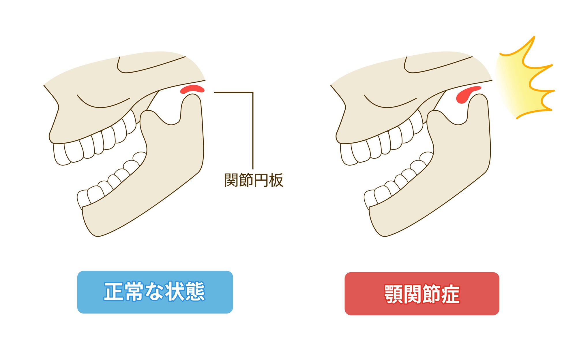 顎関節症の原因