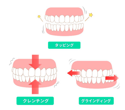 歯ぎしり・食いしばり