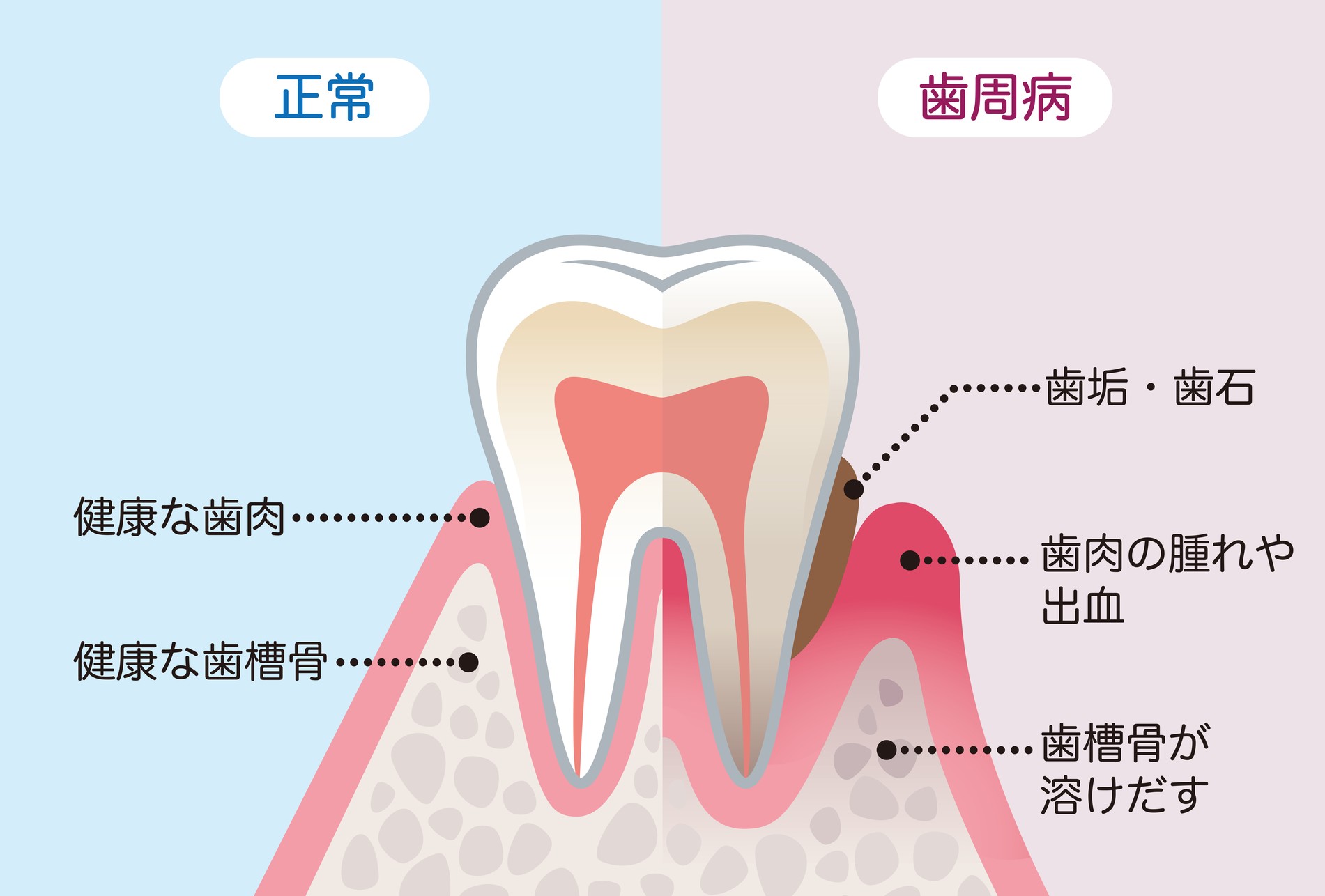 歯周病の原因